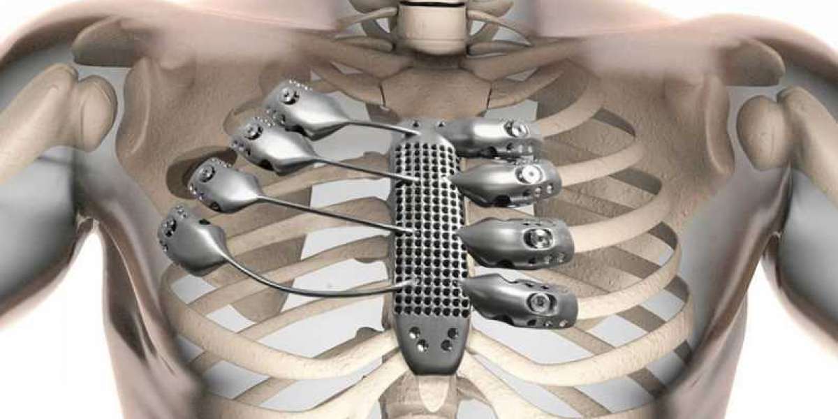 Unveiling the Truths Behind Metal Implants and Cancer