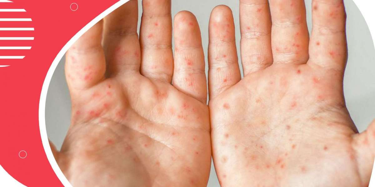 Hand, Foot, and Mouth Disease Treatment Market 2024-2032 Market Innovators to Watch