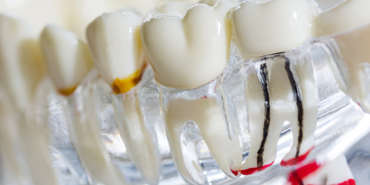 How To Choose The Right Endodontist For Your Root Canal Treatment In Dearborn?