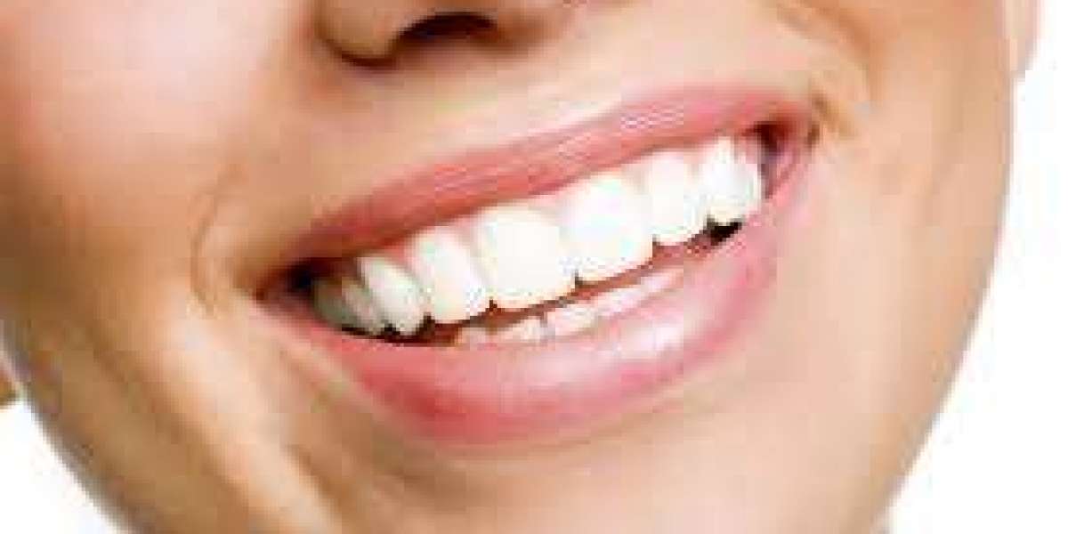 Teeth Whitening in Waltham Cross & Composite Bonding in the UK