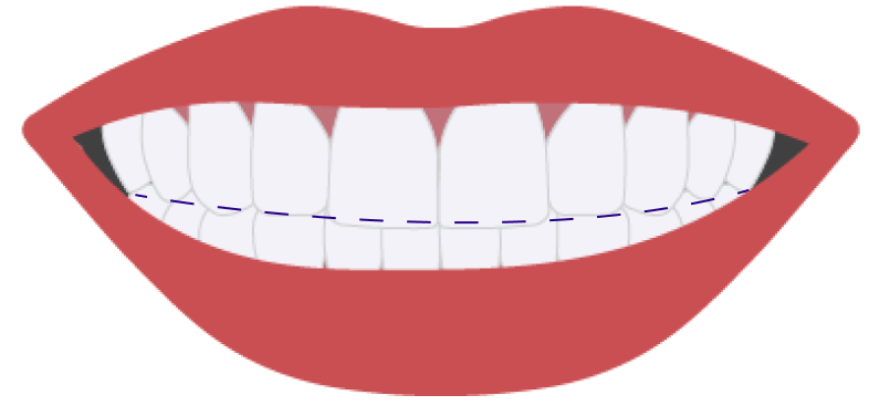 Westwood Braces | Hillsdale Invisalign | Emerson Braces- Ilya Lipkin DDS