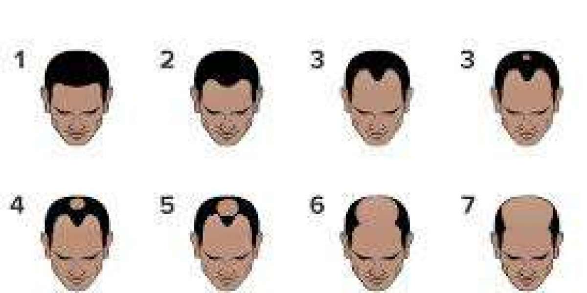 Is India Good for Hair Transplants