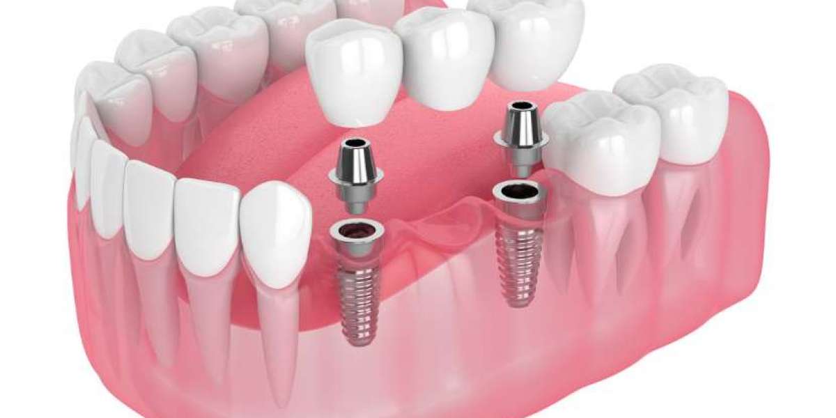 Global Dental Implants Market | Share | Size | Trends | Outlook | Growth | Forecast | 2024 - 2032