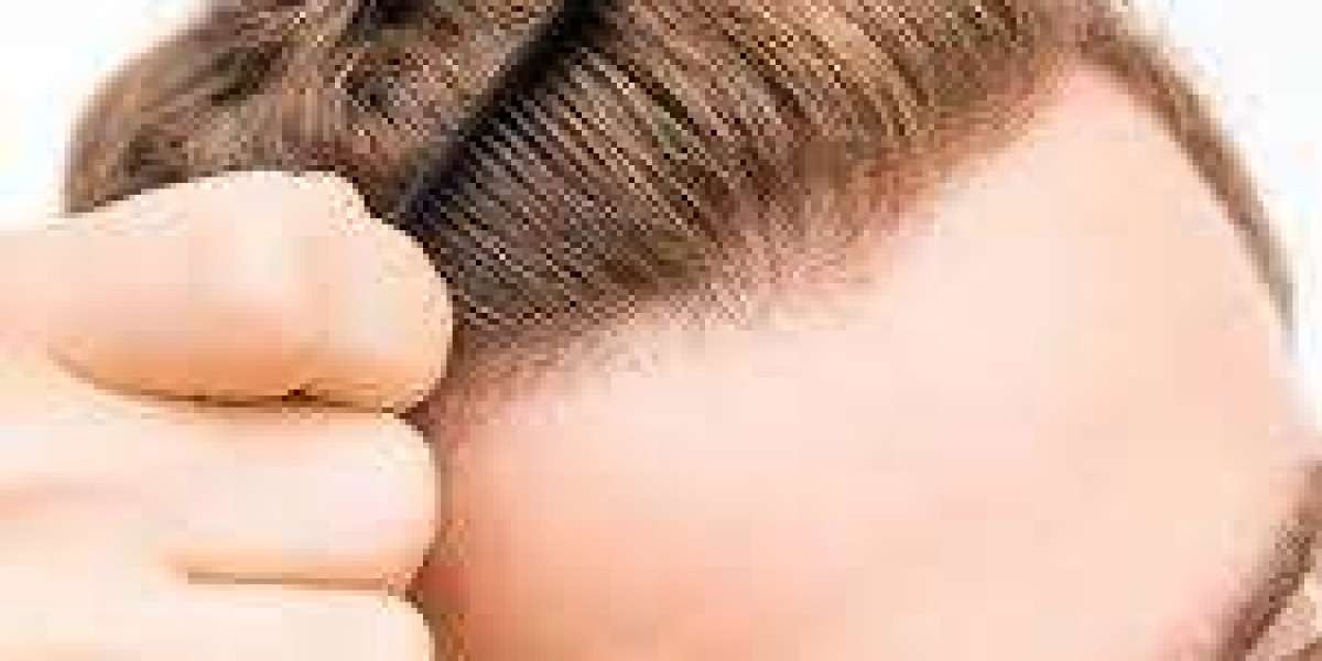 The Definitive Guide to Hair Transplants in Riyadh