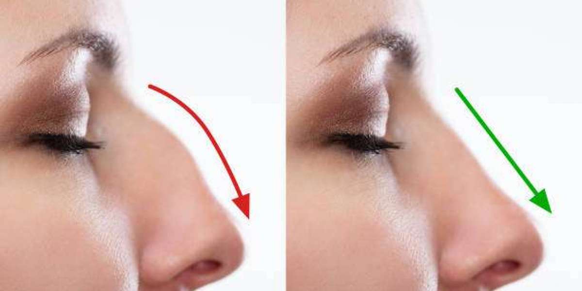 Rhinoplasty in Dubai: Which Trend is Popular in 2024?