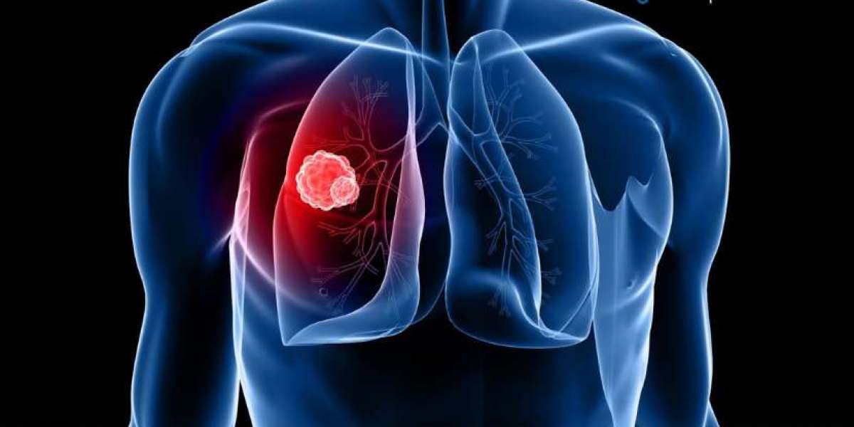 Lung Cancer Screening Market Size, Share, Trends 2024-2032