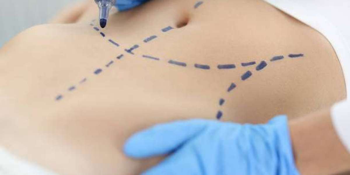 Liposuction Surgery in Dubai: From Consultation to Recovery