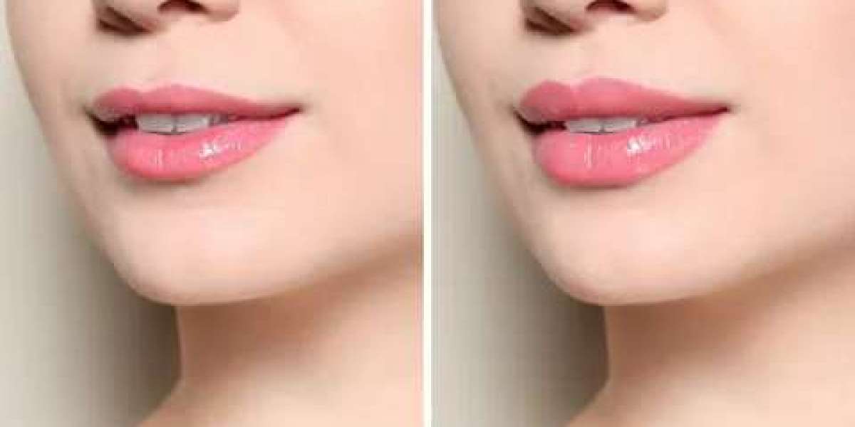 Transformative Results: Real Stories from Lip Reduction Patients in Dubai