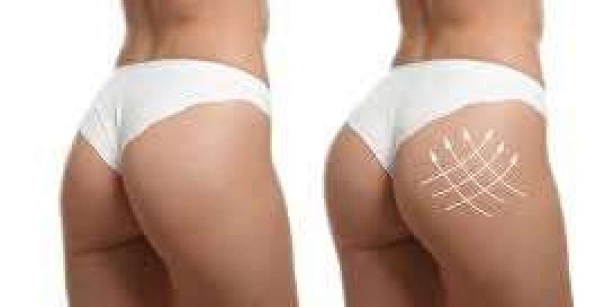 Elevate Your Body Confidence: Buttock Augmentation in Dubai