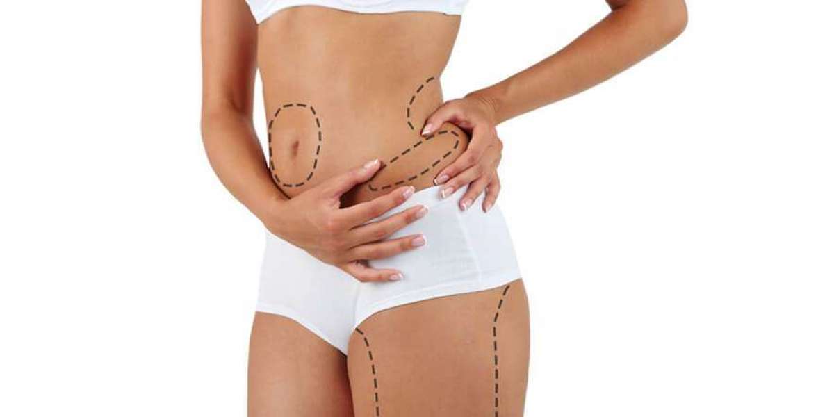 What to Expect During Your First Liposuction Consultation in Islamabad