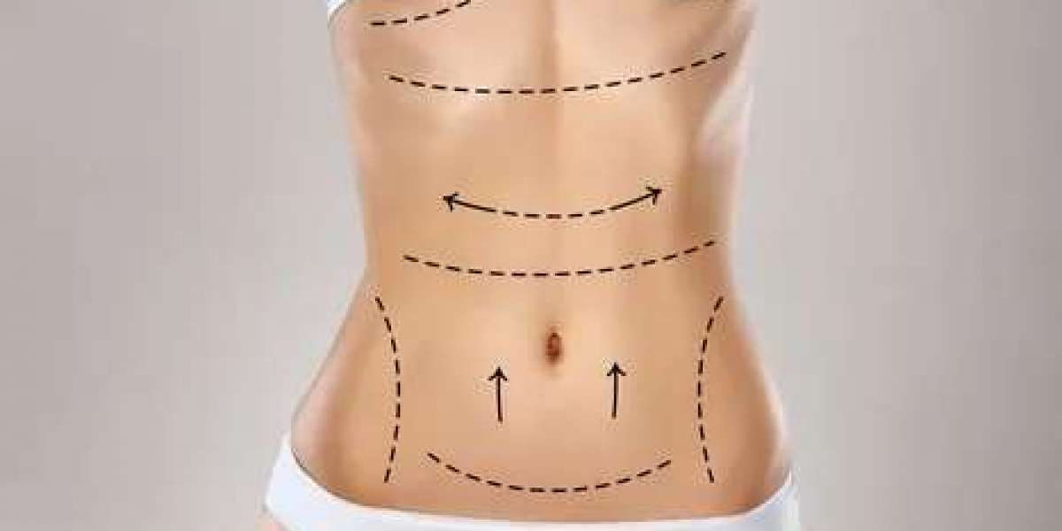 Tummy Tuck in Dubai: Redefining Body Contouring Excellence