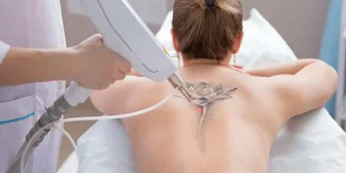 Laser Tattoo Removal in Riyadh: A Comprehensive Guide