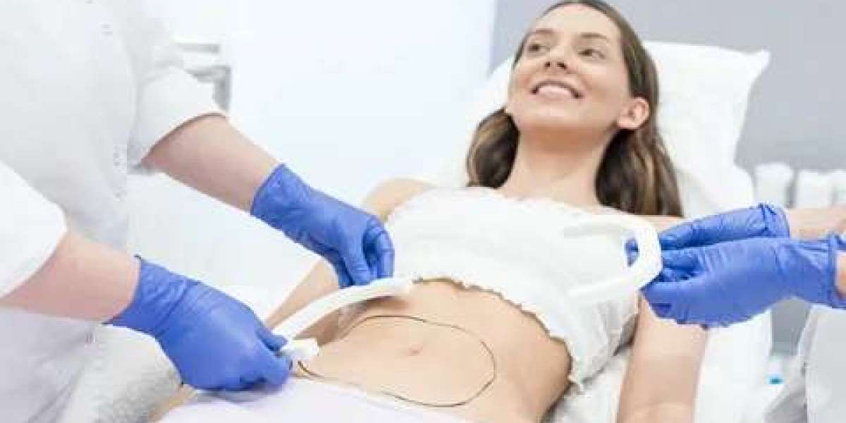 Finding the Best Liposuction Surgeons in Dubai