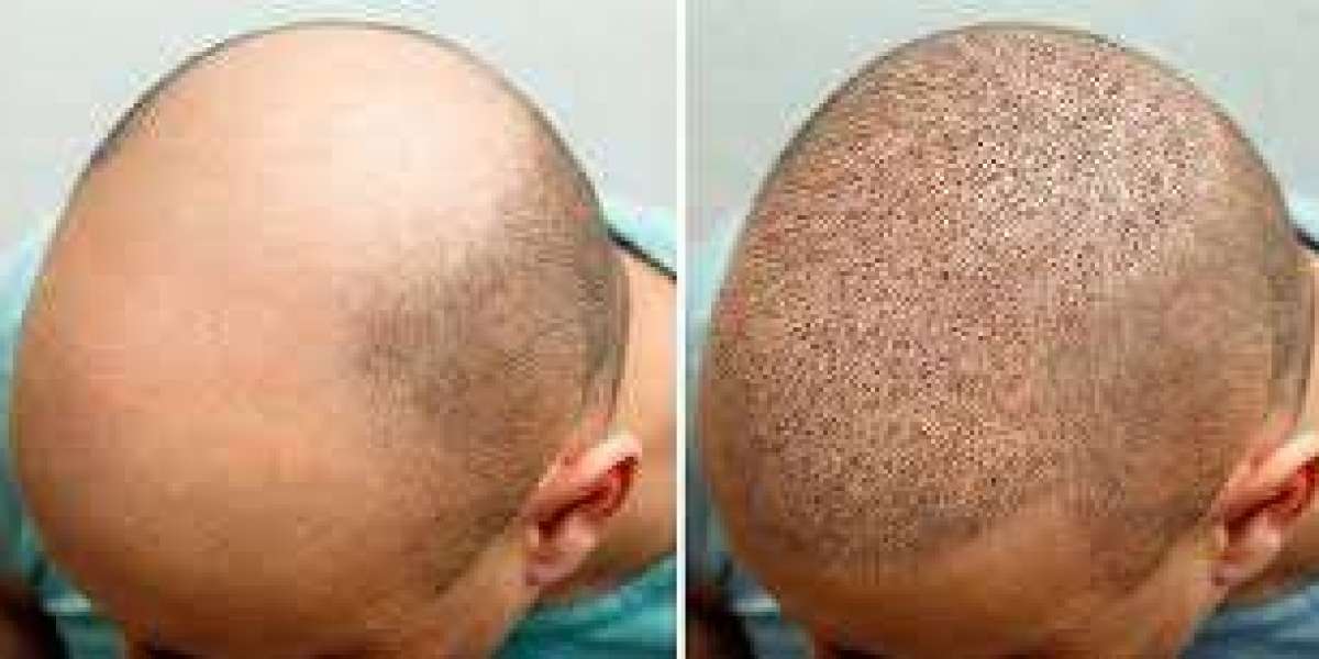 All You Need to Know About Hair Transplants in Riyadh