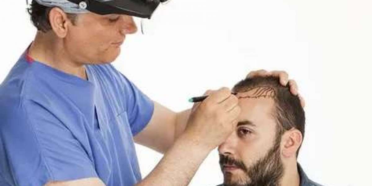 Hair Transplant in Riyadh: A Step Towards Confidence