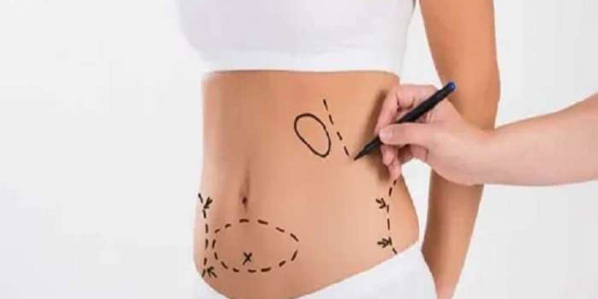 Liposuction in Riyadh: A Path to Body Contouring and Confidence