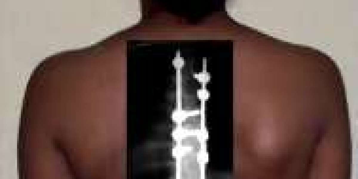 Everything You Need to Know About Spine Surgery in India and Finding the Top Surgeons in Bangalore