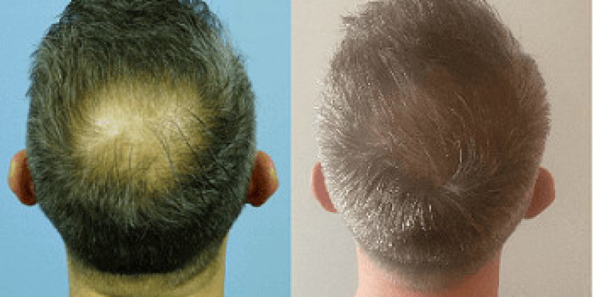 Riyadh's Hair Restoration Revolution Finding the Best Exosome Clinic