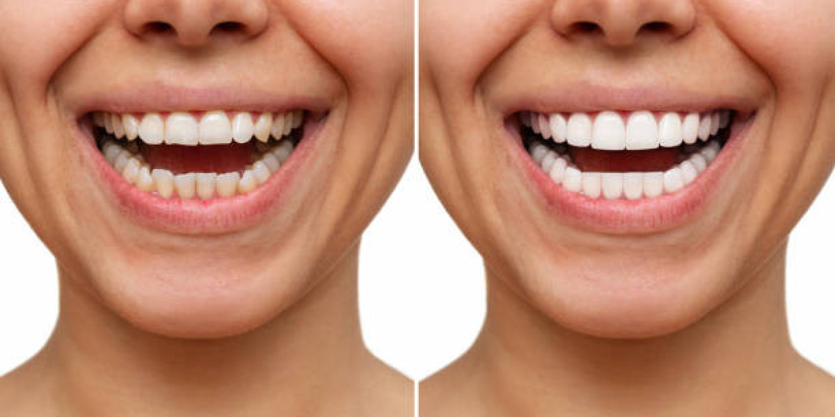 Do Composite Veneers Work for Small or Short Teeth?