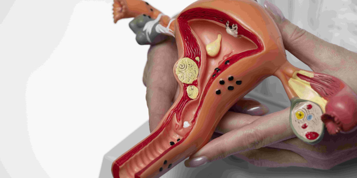 Why Endometriosis Often Goes Undiagnosed for Years