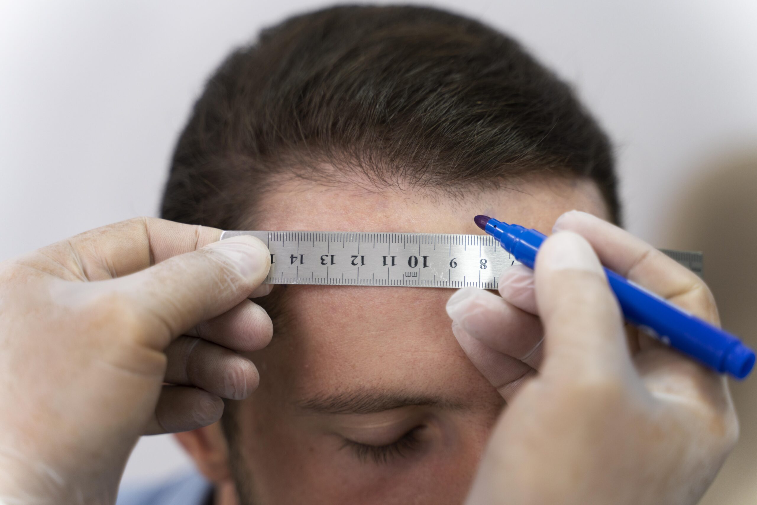 Best Hair Transplant Los Angeles | ZMD Hair Clinic 2026