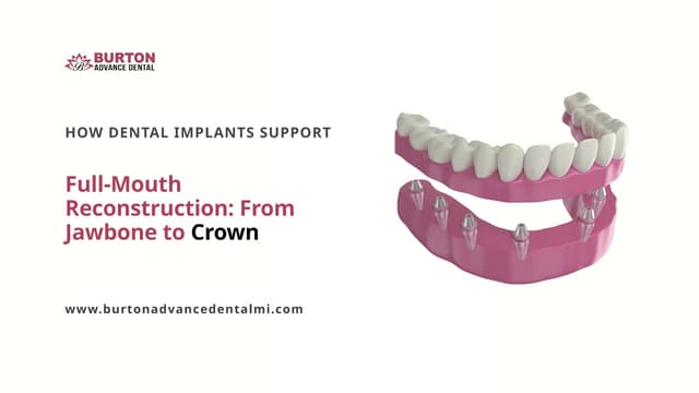 How Dental Implants Support  Full-Mouth Reconstruction From Jawbone to Crown | PPTX