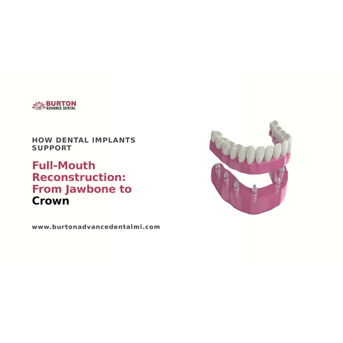 How Dental Implants Support Full Mouth Reconstruction