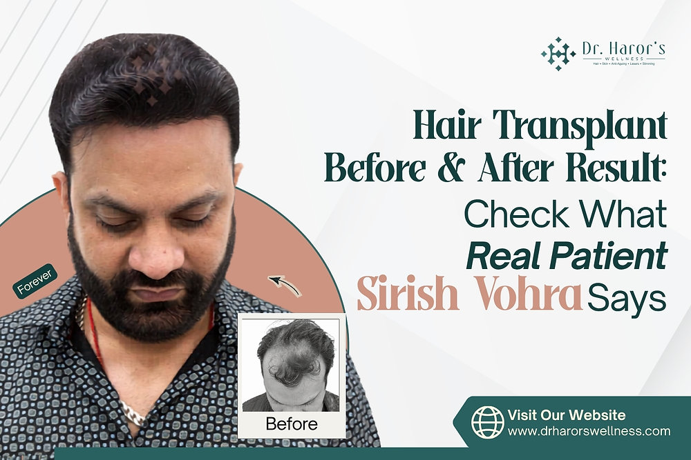 Hair Transplant Before & After Result: Check What Real Patient Sirish Vohra Says