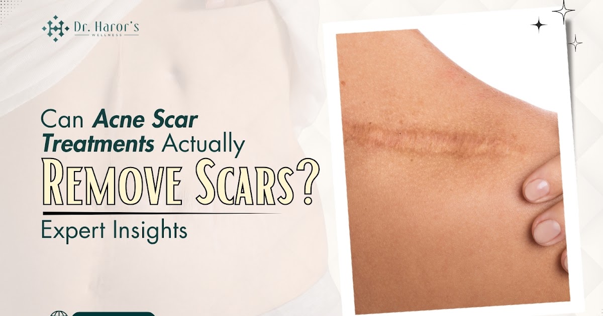 Can Acne Scar Treatments Actually Remove Scars? Expert Insights