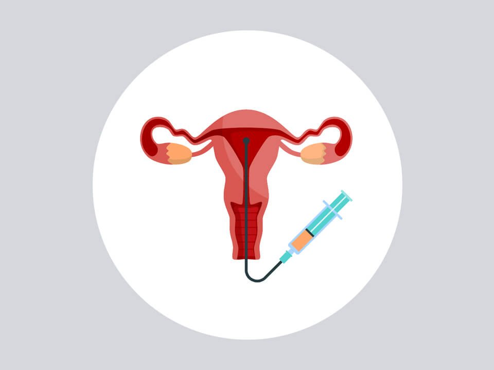 Advanced IUI Treatment in Delhi | Dr Tuhina Goel