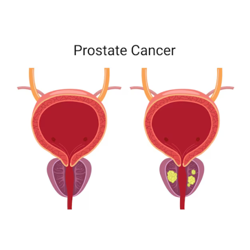 Living Comfortably with BPH: Expert Care from a Prostate Specialist in Irvine, CA
